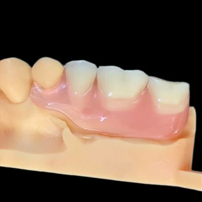 Tsis muaj Hlau Clasp Flexible Partial Denture